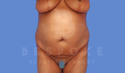 Tummy Tuck Before & After Gallery - Patient 144120577 - Image 1