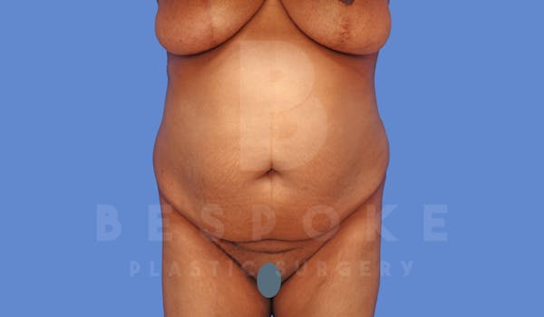 Tummy Tuck Before & After Gallery - Patient 144120577 - Image 1