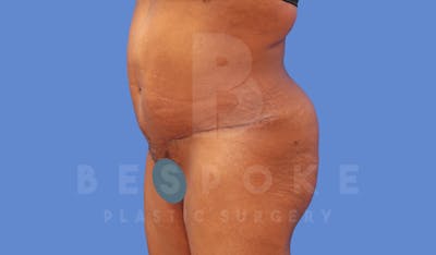 Tummy Tuck Before & After Gallery - Patient 144120577 - Image 4