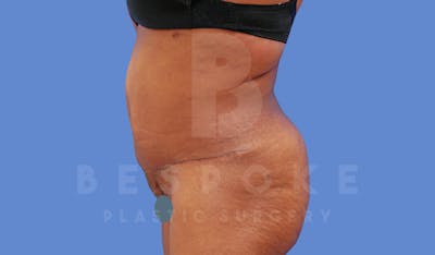 Tummy Tuck Before & After Gallery - Patient 144120577 - Image 6