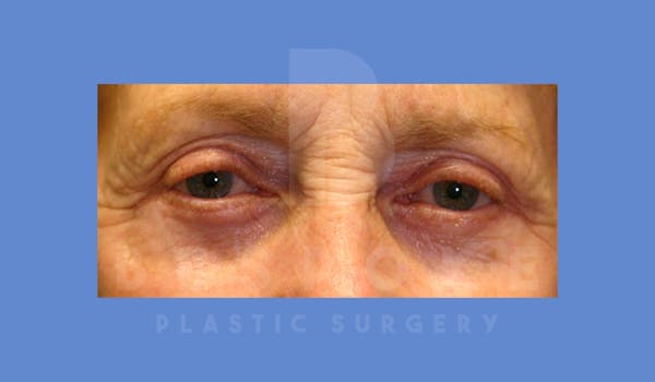 Eyelid Surgery Before & After Gallery - Patient 144156771 - Image 2