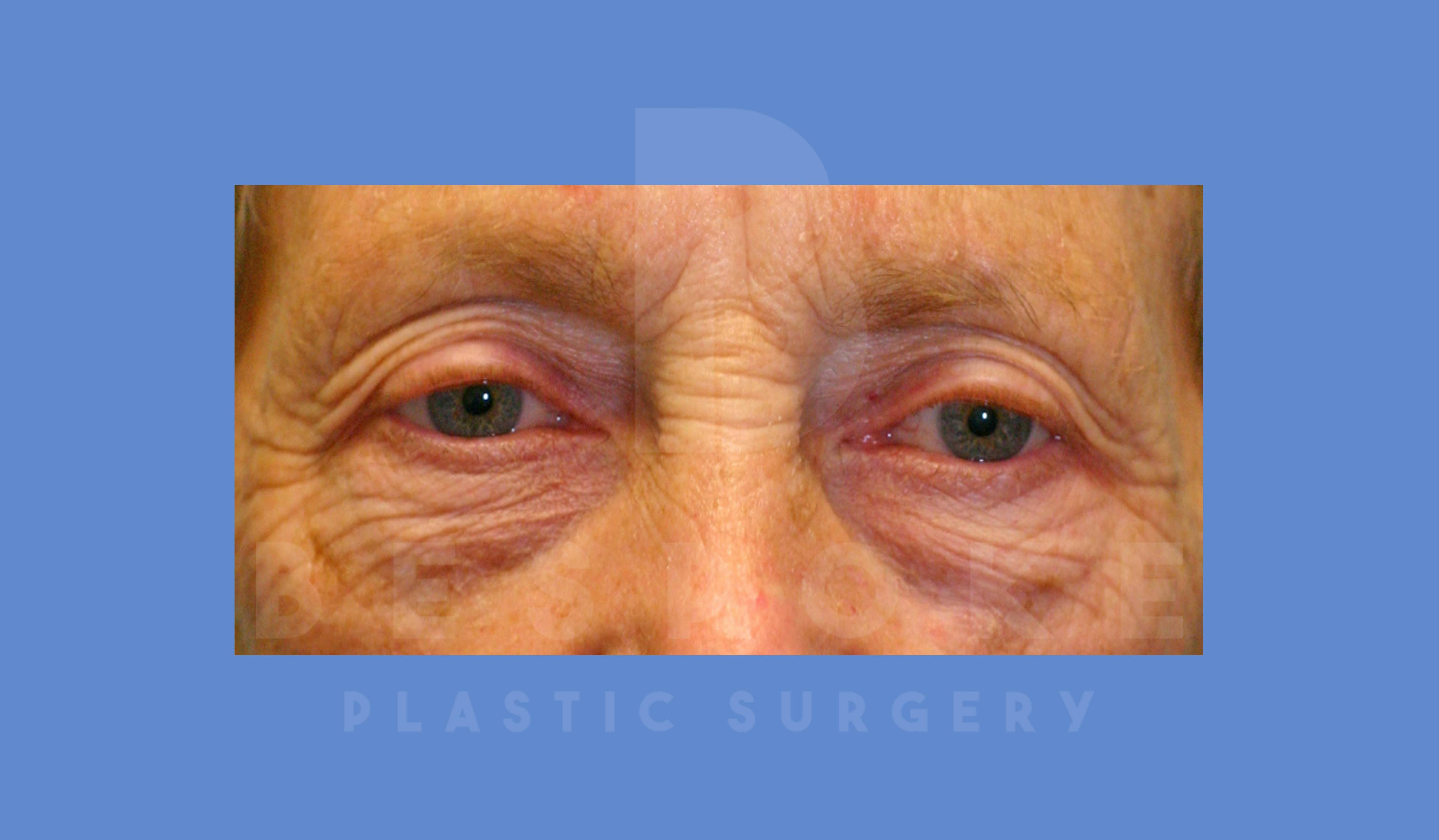 Eyelid Surgery Before & After Gallery - Patient 144156771 - Image 1
