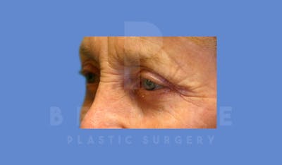 Eyelid Surgery Before & After Gallery - Patient 144156771 - Image 4