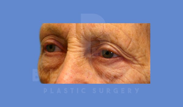 Eyelid Surgery Before & After Gallery - Patient 144156771 - Image 3