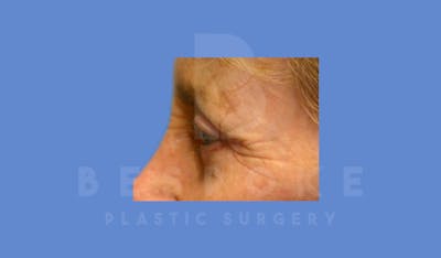 Eyelid Surgery Before & After Gallery - Patient 144156771 - Image 6