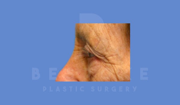 Eyelid Surgery Before & After Gallery - Patient 144156771 - Image 5