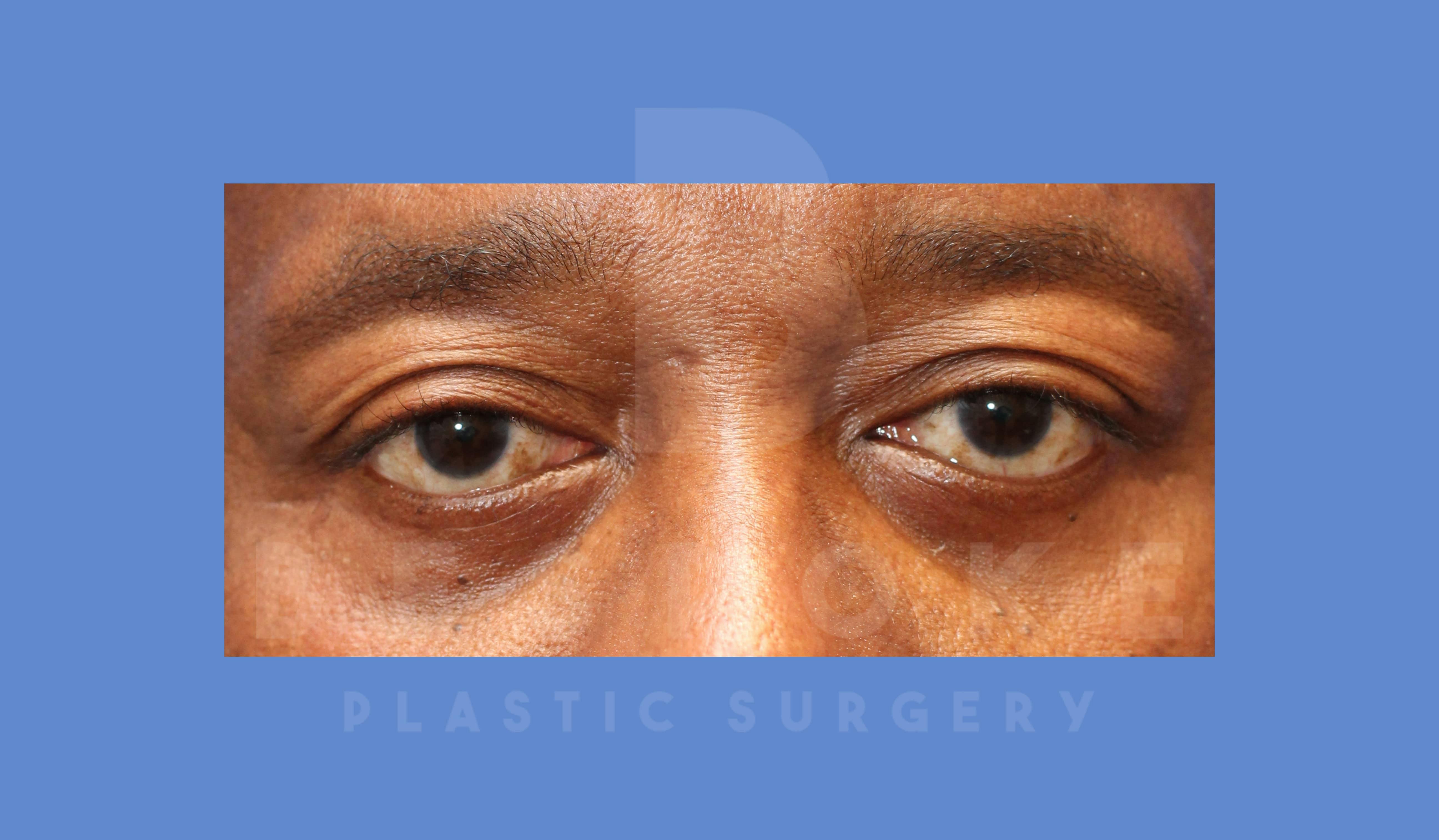 Eyelid Surgery Before & After Gallery - Patient 144156772 - Image 2