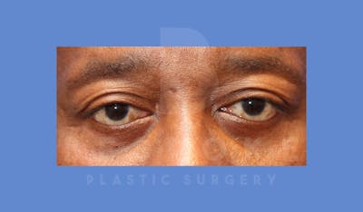 Eyelid Surgery Before & After Gallery - Patient 144156772 - Image 2
