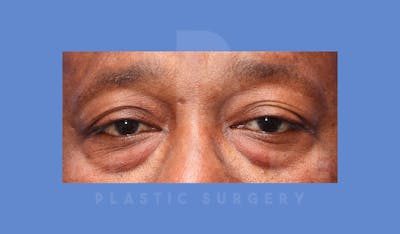 Eyelid Surgery Before & After Gallery - Patient 144156772 - Image 1