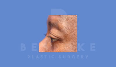 Eyelid Surgery Before & After Gallery - Patient 144156772 - Image 4