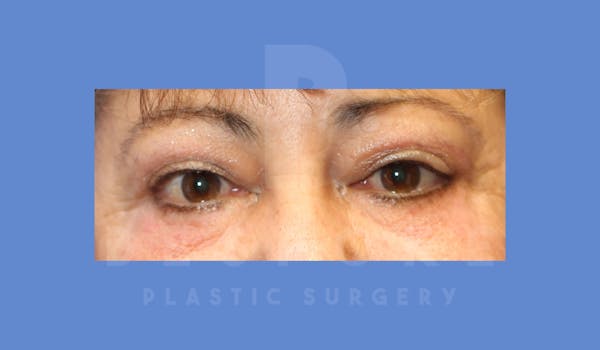 Eyelid Surgery Before & After Gallery - Patient 144156773 - Image 2
