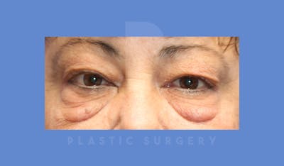 Eyelid Surgery Before & After Gallery - Patient 144156773 - Image 1