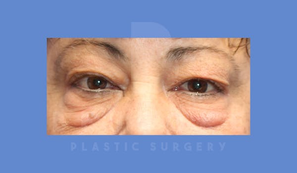 Eyelid Surgery Before & After Gallery - Patient 144156773 - Image 1