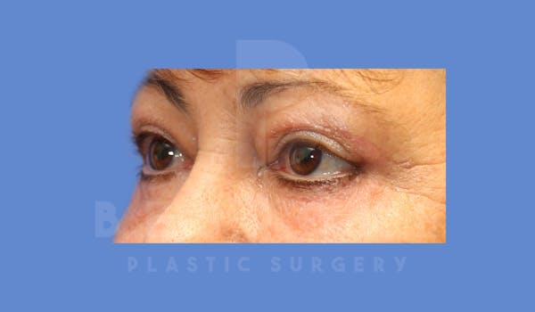 Eyelid Surgery Before & After Gallery - Patient 144156773 - Image 4
