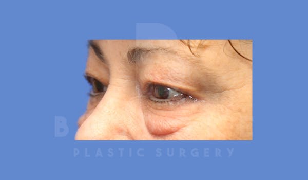 Eyelid Surgery Before & After Gallery - Patient 144156773 - Image 3