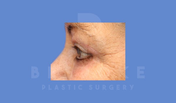 Eyelid Surgery Before & After Gallery - Patient 144156773 - Image 6