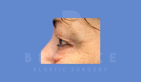 Eyelid Surgery Before & After Gallery - Patient 144156773 - Image 5