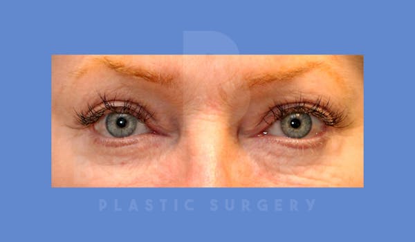 Eyelid Surgery Before & After Gallery - Patient 144156774 - Image 2