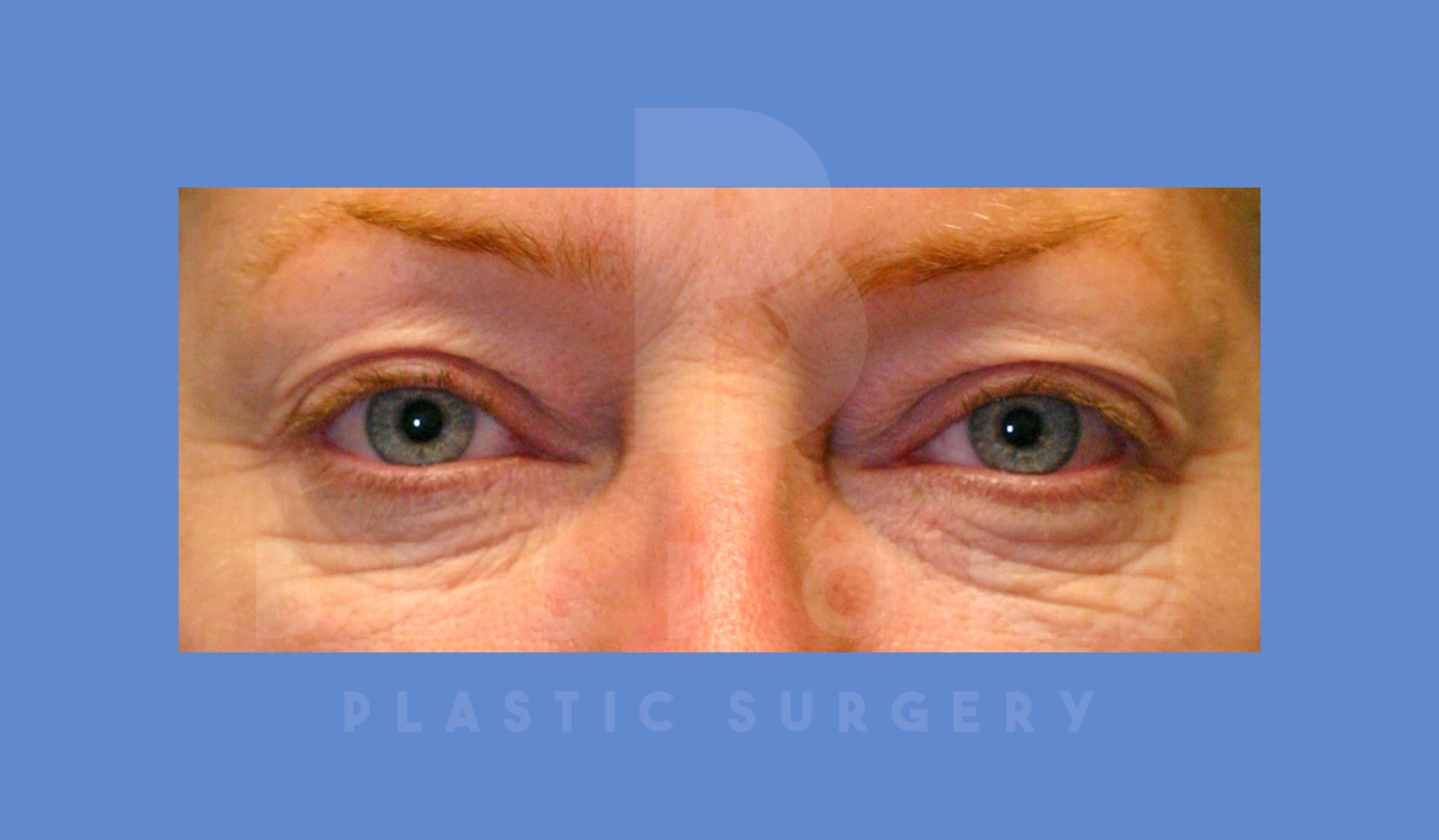 Eyelid Surgery Before & After Gallery - Patient 144156774 - Image 1