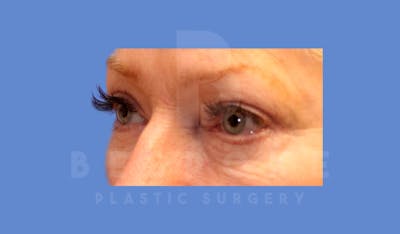 Eyelid Surgery Before & After Gallery - Patient 144156774 - Image 4