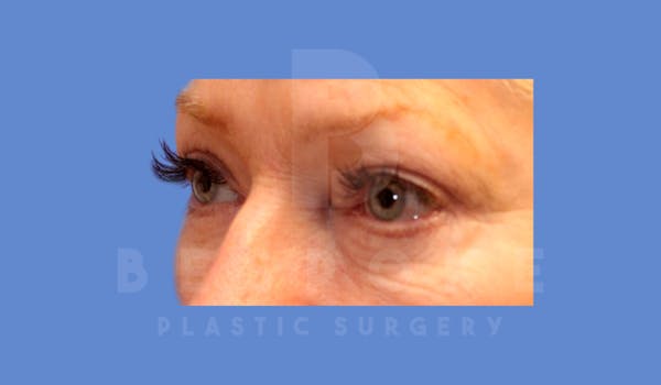Eyelid Surgery Before & After Gallery - Patient 144156774 - Image 4