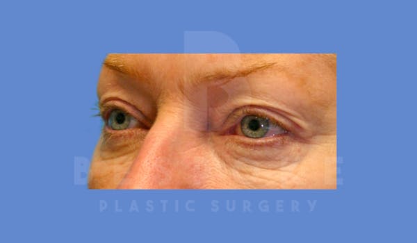 Eyelid Surgery Before & After Gallery - Patient 144156774 - Image 3