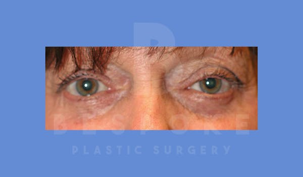 Eyelid Surgery Before & After Gallery - Patient 144156775 - Image 2