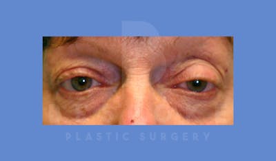 Eyelid Surgery Before & After Gallery - Patient 144156775 - Image 1