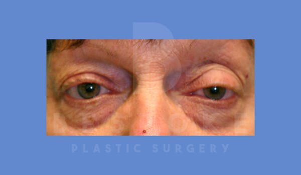 Eyelid Surgery Before & After Gallery - Patient 144156775 - Image 1