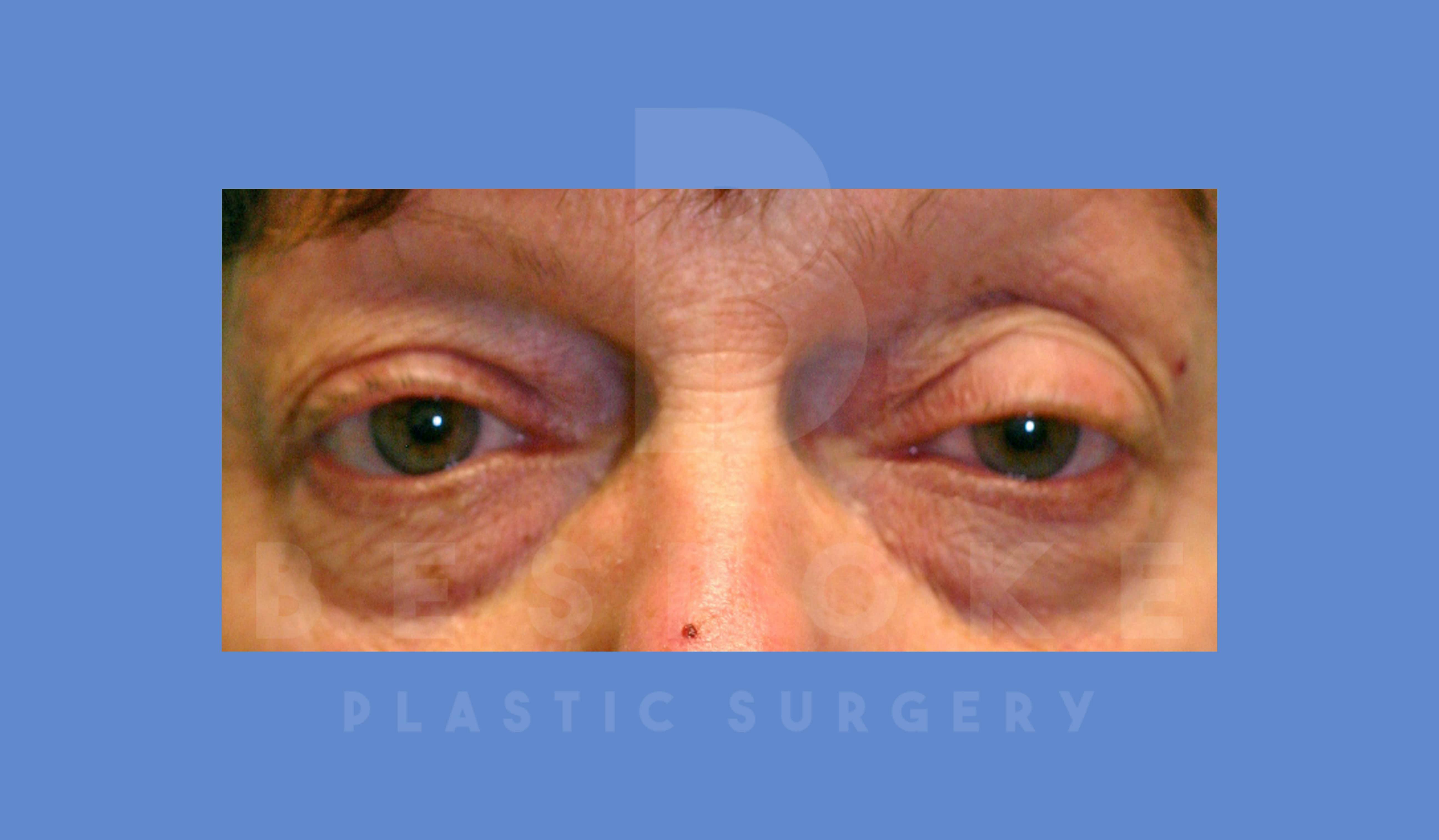 Eyelid Surgery Before & After Gallery - Patient 144156775 - Image 1