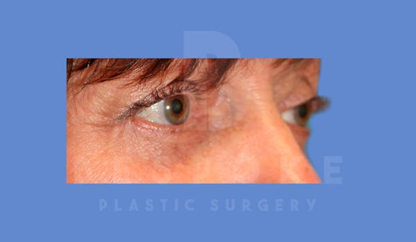 Eyelid Surgery Before & After Gallery - Patient 144156775 - Image 4