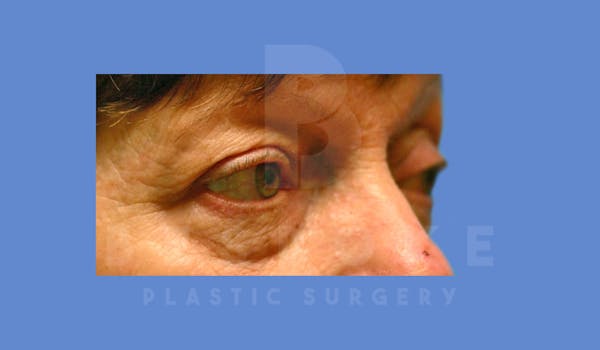 Eyelid Surgery Before & After Gallery - Patient 144156775 - Image 3