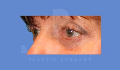 Eyelid Surgery Before & After Gallery - Patient 144156775 - Image 6