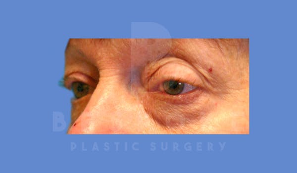 Eyelid Surgery Before & After Gallery - Patient 144156775 - Image 5