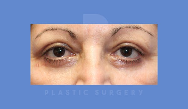 Eyelid Surgery Before & After Gallery - Patient 144156776 - Image 2