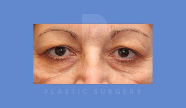 Eyelid Surgery Before & After Gallery - Patient 144156776 - Image 1