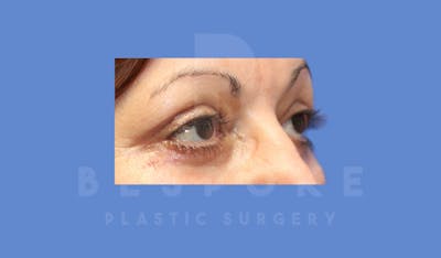 Eyelid Surgery Before & After Gallery - Patient 144156776 - Image 4
