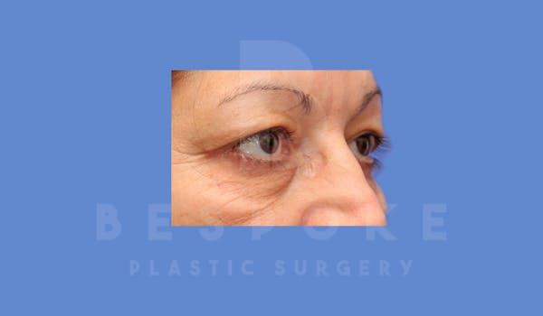 Eyelid Surgery Before & After Gallery - Patient 144156776 - Image 3