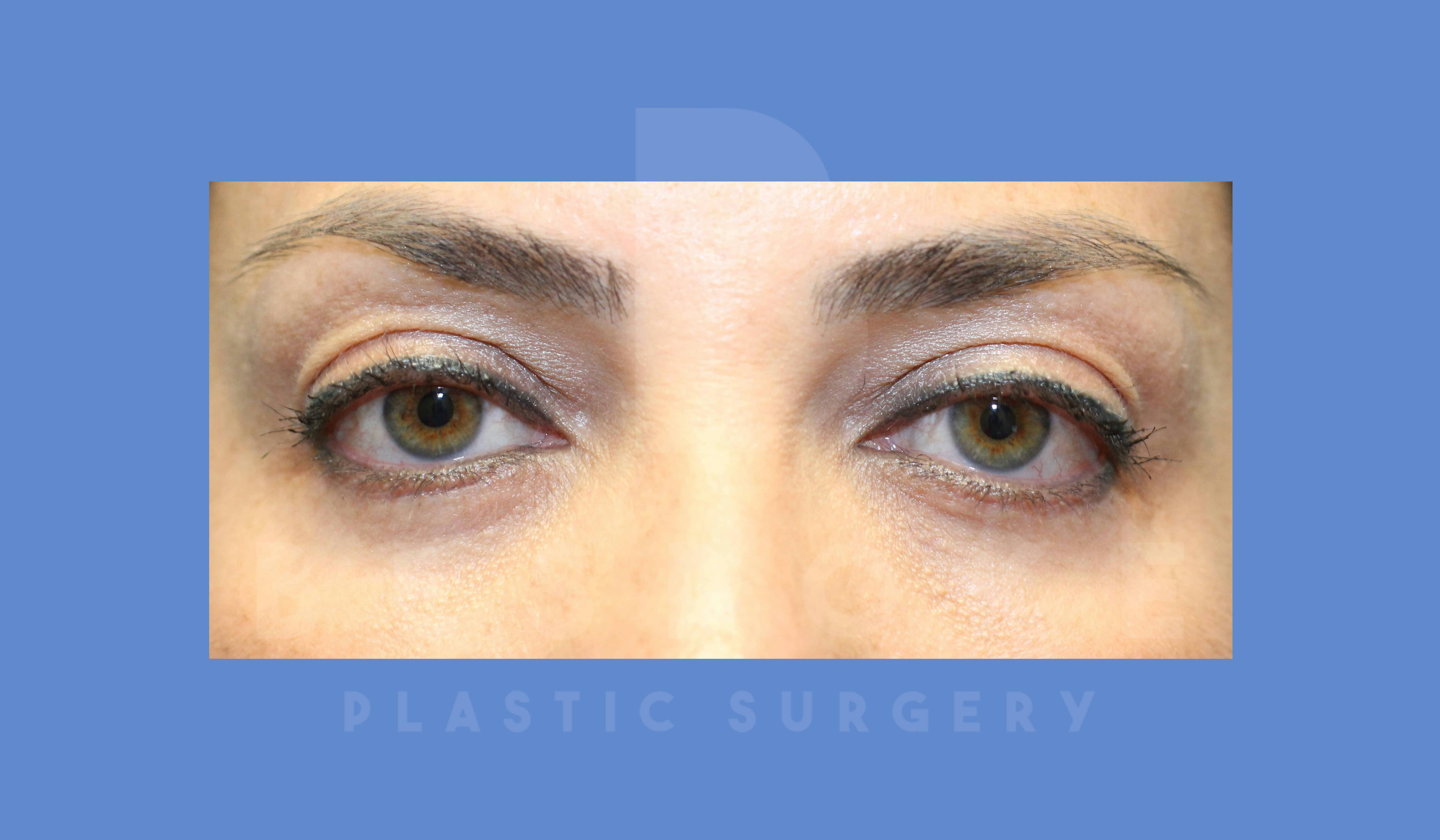 Eyelid Surgery Before & After Gallery - Patient 144156777 - Image 2