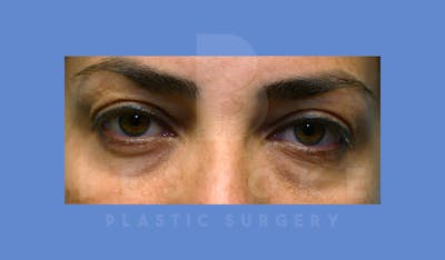 Eyelid Surgery Before & After Gallery - Patient 144156777 - Image 1