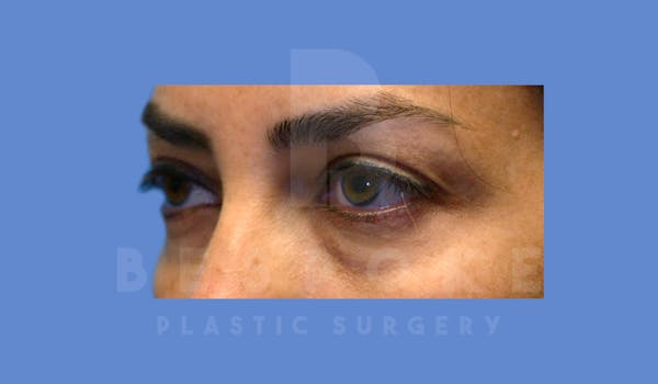 Eyelid Surgery Before & After Gallery - Patient 144156777 - Image 4