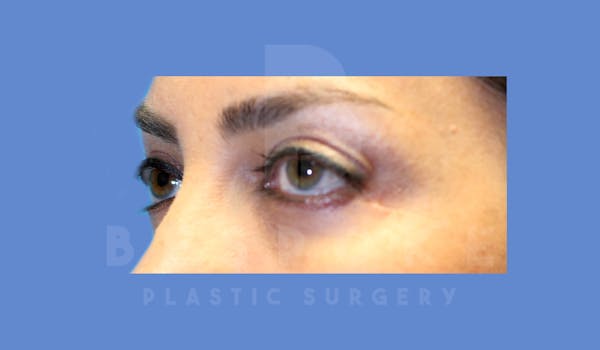 Eyelid Surgery Before & After Gallery - Patient 144156777 - Image 3
