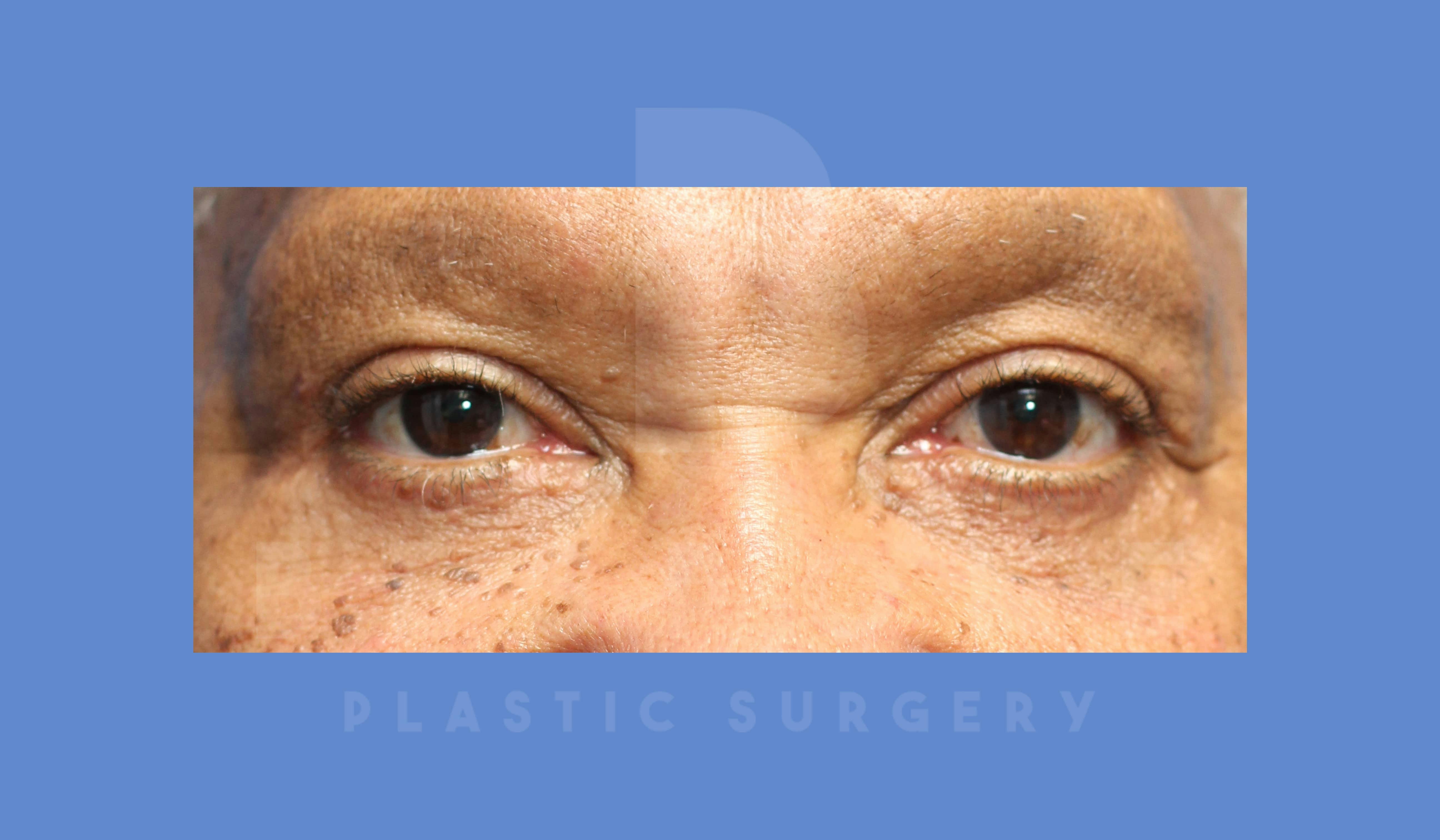 Eyelid Surgery Before & After Gallery - Patient 144156779 - Image 2