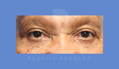 Eyelid Surgery Before & After Gallery - Patient 144156779 - Image 2