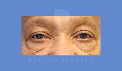 Eyelid Surgery Before & After Gallery - Patient 144156779 - Image 1