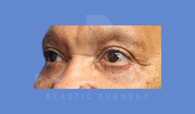 Eyelid Surgery Before & After Gallery - Patient 144156779 - Image 4