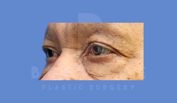 Eyelid Surgery Before & After Gallery - Patient 144156779 - Image 3