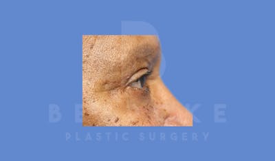 Eyelid Surgery Before & After Gallery - Patient 144156779 - Image 6