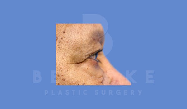 Eyelid Surgery Before & After Gallery - Patient 144156779 - Image 5