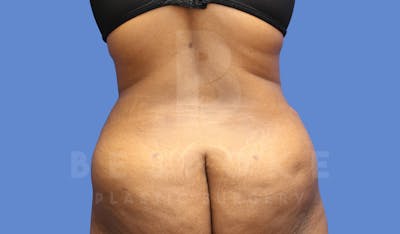 Brazilian Butt Lift Before & After Gallery - Patient 144169816 - Image 2